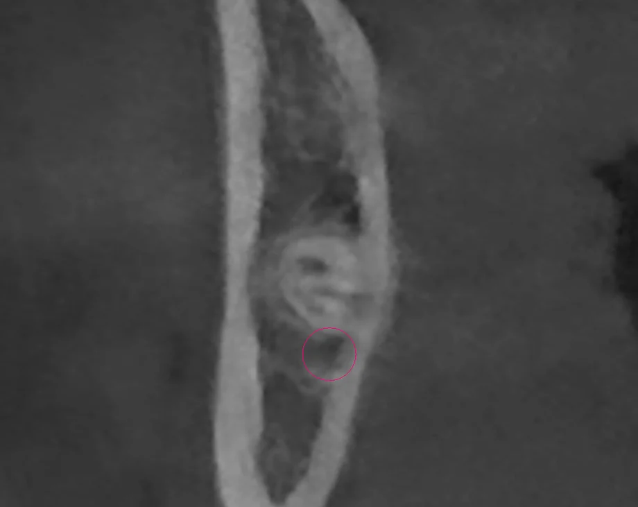 저선량 3D CT 관상면 단면 — 하치조신경관의 단면 위치와 피질 경계를 확인한 실제 진단 영상