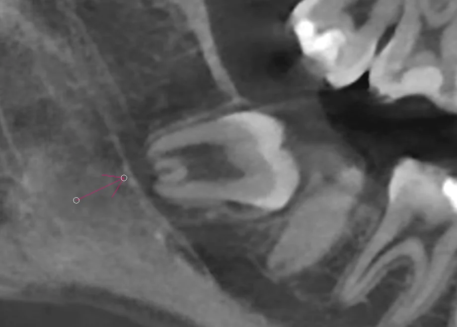 저선량 3D CT 시상면 단면 — 매복 사랑니 치근과 하치조신경관 사이의 거리를 측정한 실제 진단 영상