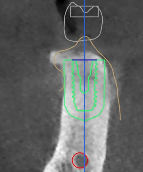 식립 계획 3D CT 단면 — 잇몸뼈 높이와 픽스처 끝에서 하치조신경까지의 거리를 확인한 실제 계획 영상