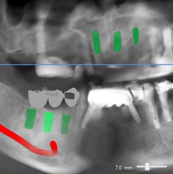 식립 계획 3D CT 파노라마 — 한 턱에 여러 개의 임플란트 픽스처를 하치조신경관을 피해 배치한 실제 계획 영상