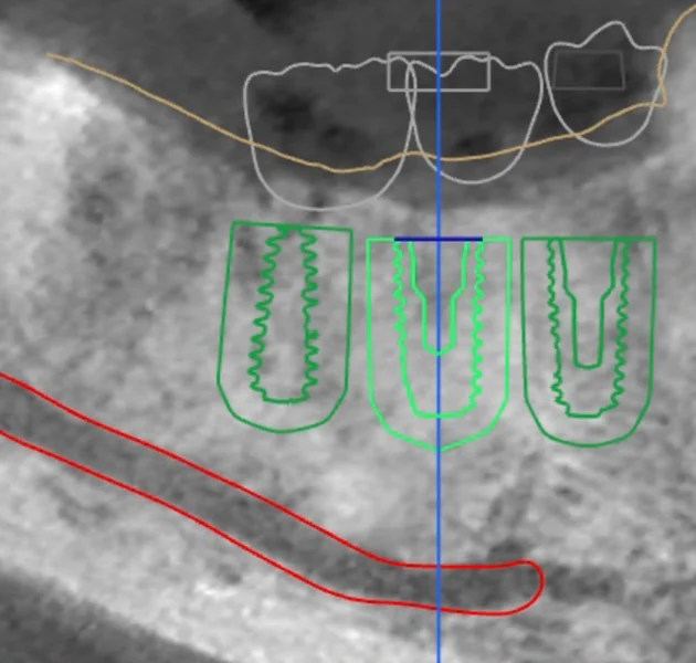 식립 계획 3D CT 시상면 — 여러 개의 픽스처가 하치조신경관 위쪽 잇몸뼈에 배치된 실제 계획 영상