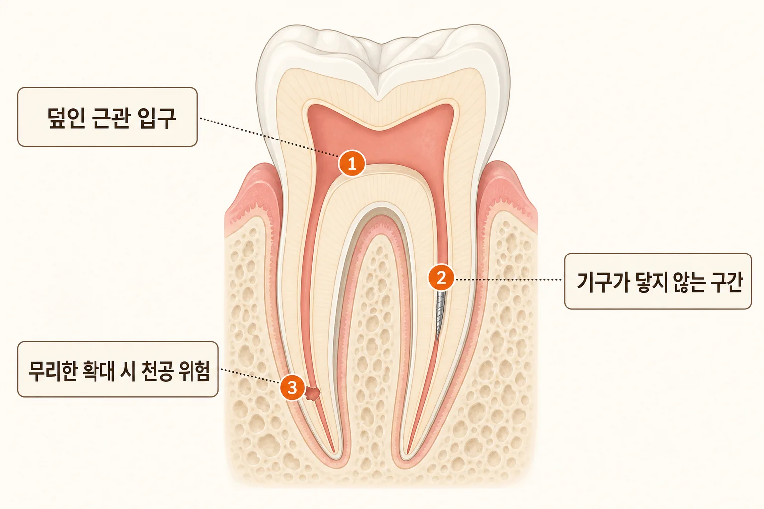 석회화 근관에서 근관 입구 탐색, 기구 도달의 한계, 천공 위험 세 가지를 표시한 모식도
