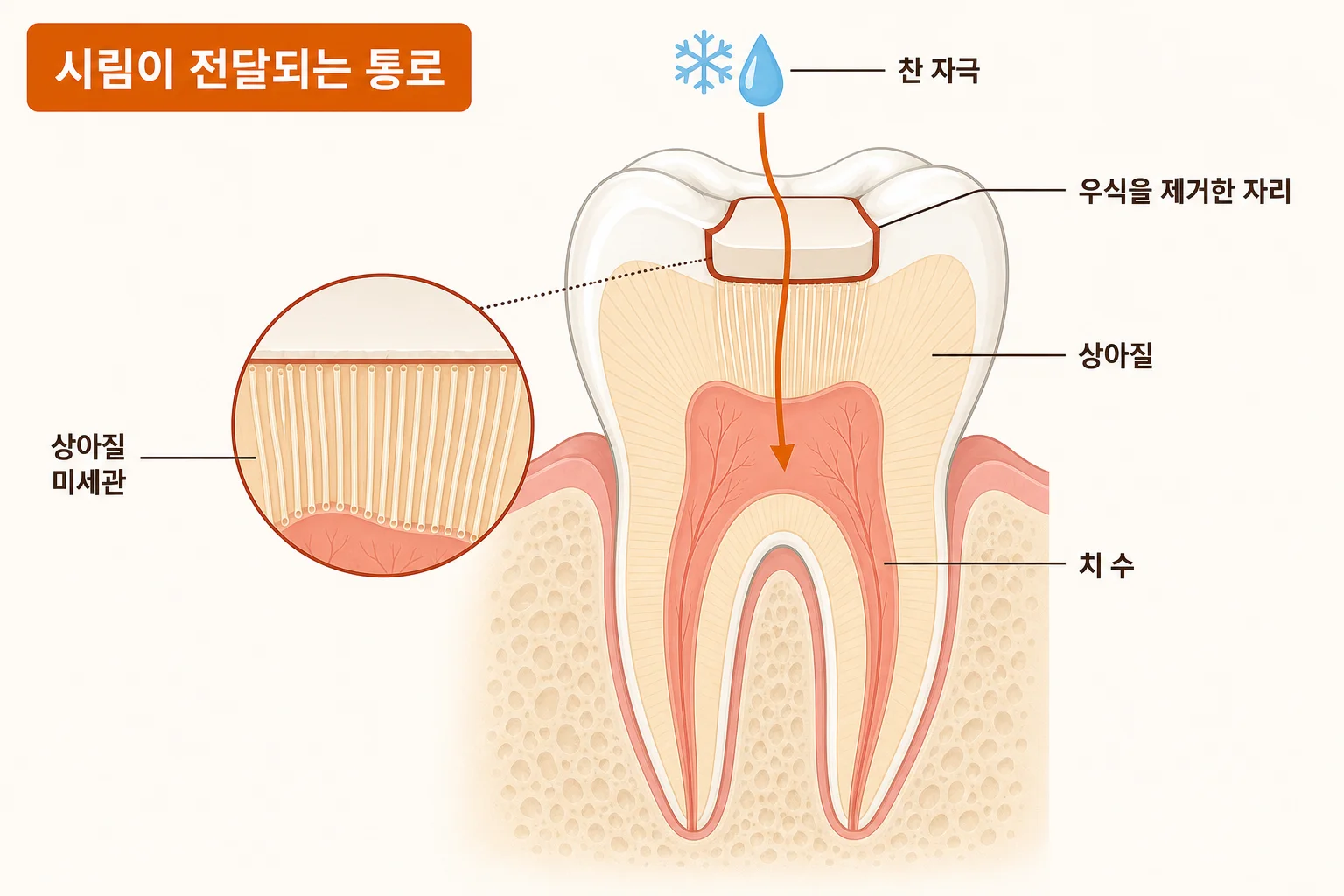 충치를 제거한 뒤 드러난 상아질의 미세관을 통해 온도 자극이 치수로 전달되는 과정을 나타낸 치아 모식도