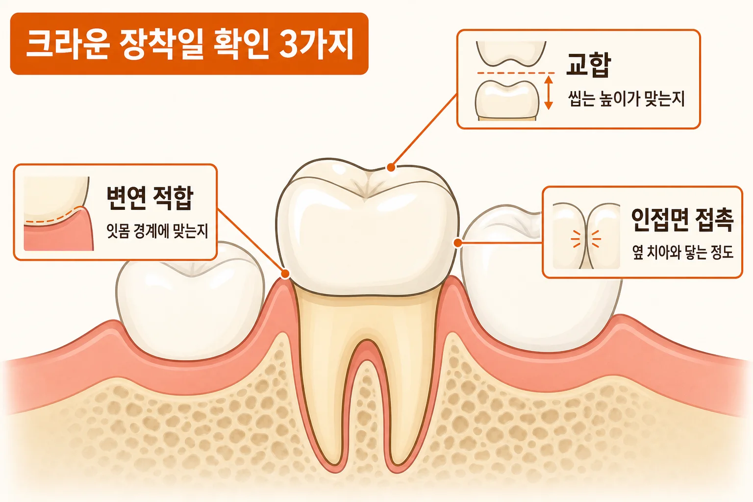 크라운 장착 전 확인하는 세 가지를 잇몸 경계 변연 적합, 씹을 때 교합 높이, 옆 치아 인접면 접촉으로 표시한 치아 모식도