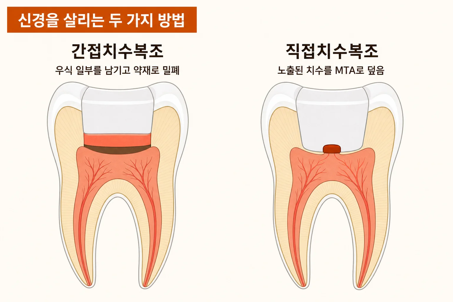 깊은 충치에서 선택적 우식 제거, 간접치수복조, 직접치수복조가 각각 어느 위치에 적용되는지 나타낸 치아 단면 모식도