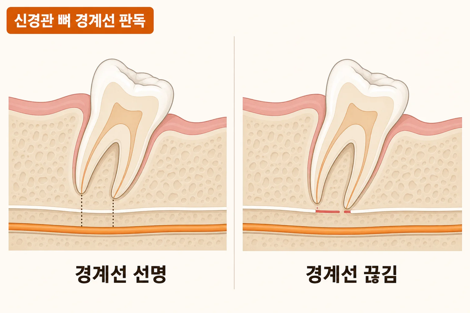 파노라마 영상에서 사랑니 뿌리와 하치조신경관이 가까운 경우를 표시한 모식도