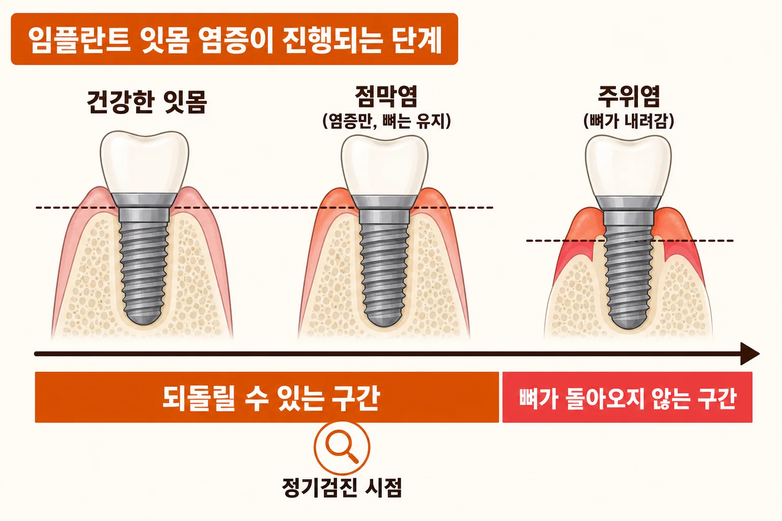 임플란트 정기검진 주기 | 왜 3개월 뒤 한 번, 그 뒤로 6개월마다인가 | 파주 서울이고운치과 내용을 설명하는 치과 진료 이미지