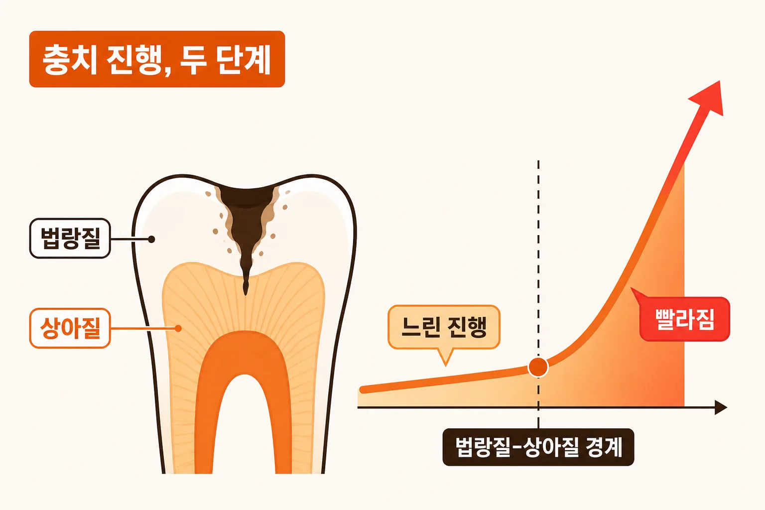 충치가 법랑질 안에서는 연 단위로 느리게 진행하다가 상아질 경계를 넘으면 빨라지는 두 단계 진행 구조를 나타낸 치아 단면 모식도