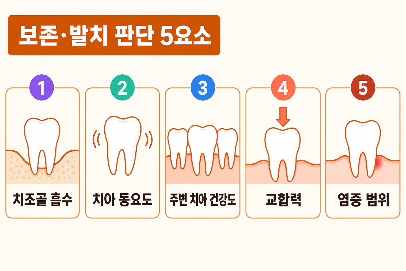 흔들리는 치아의 보존과 발치를 가르는 다섯 가지 판단 요소를 정리한 인포그래픽