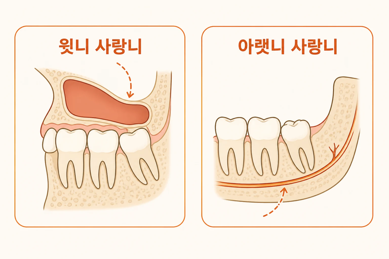 윗니 사랑니와 아랫니 사랑니 차이 | 신경관·상악동·회복 비교 | 파주 서울이고운치과 내용을 설명하는 치과 진료 이미지