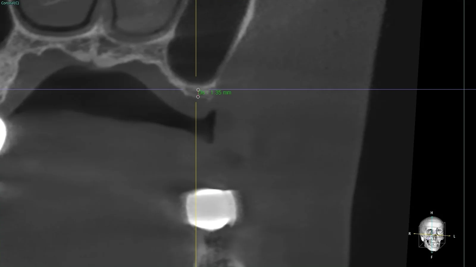 저선량 3D CT 관상면 영상, 상악동 아래 잇몸뼈 높이를 계측한 화면